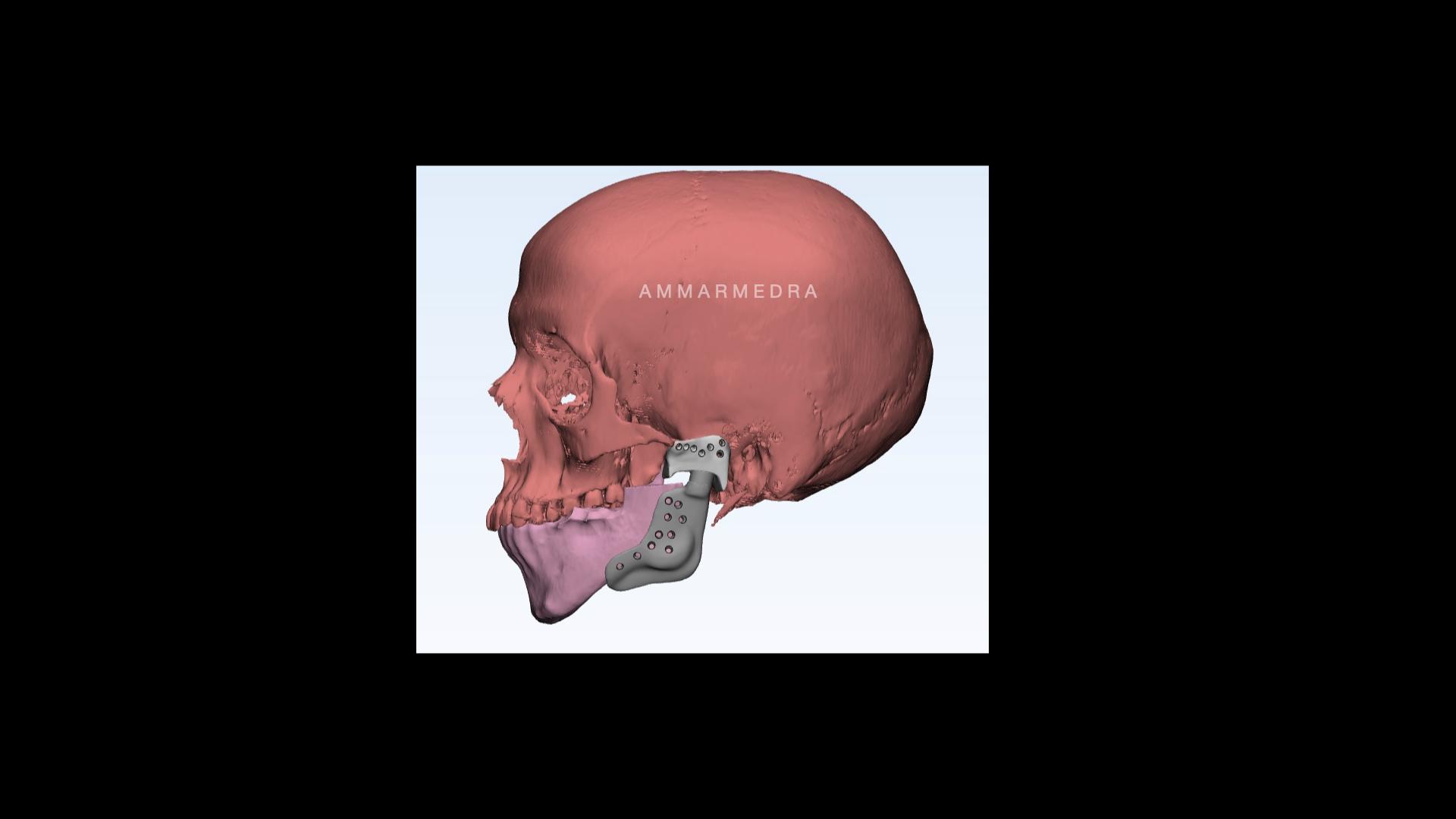 Total TMJ replacement (operated by Dr Ammar Medra)