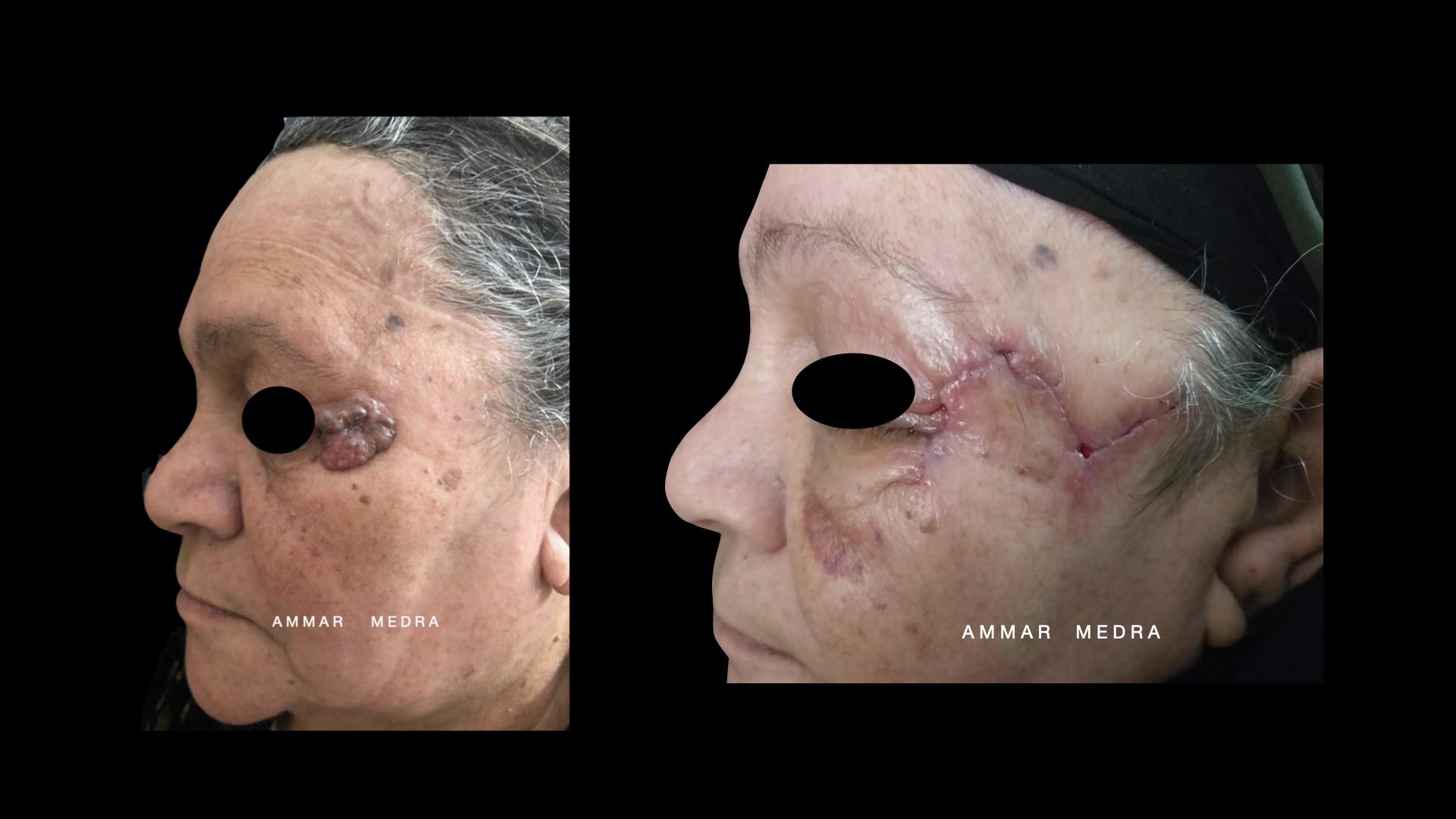 Basal cell carcinoma of the outer canthus (operated by Dr Ammar Medra)