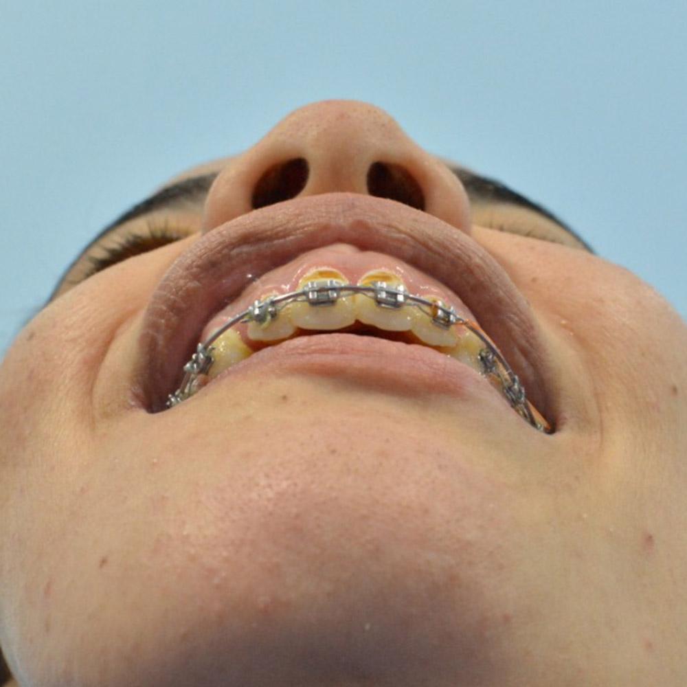 skeletal class 2 malocclusion