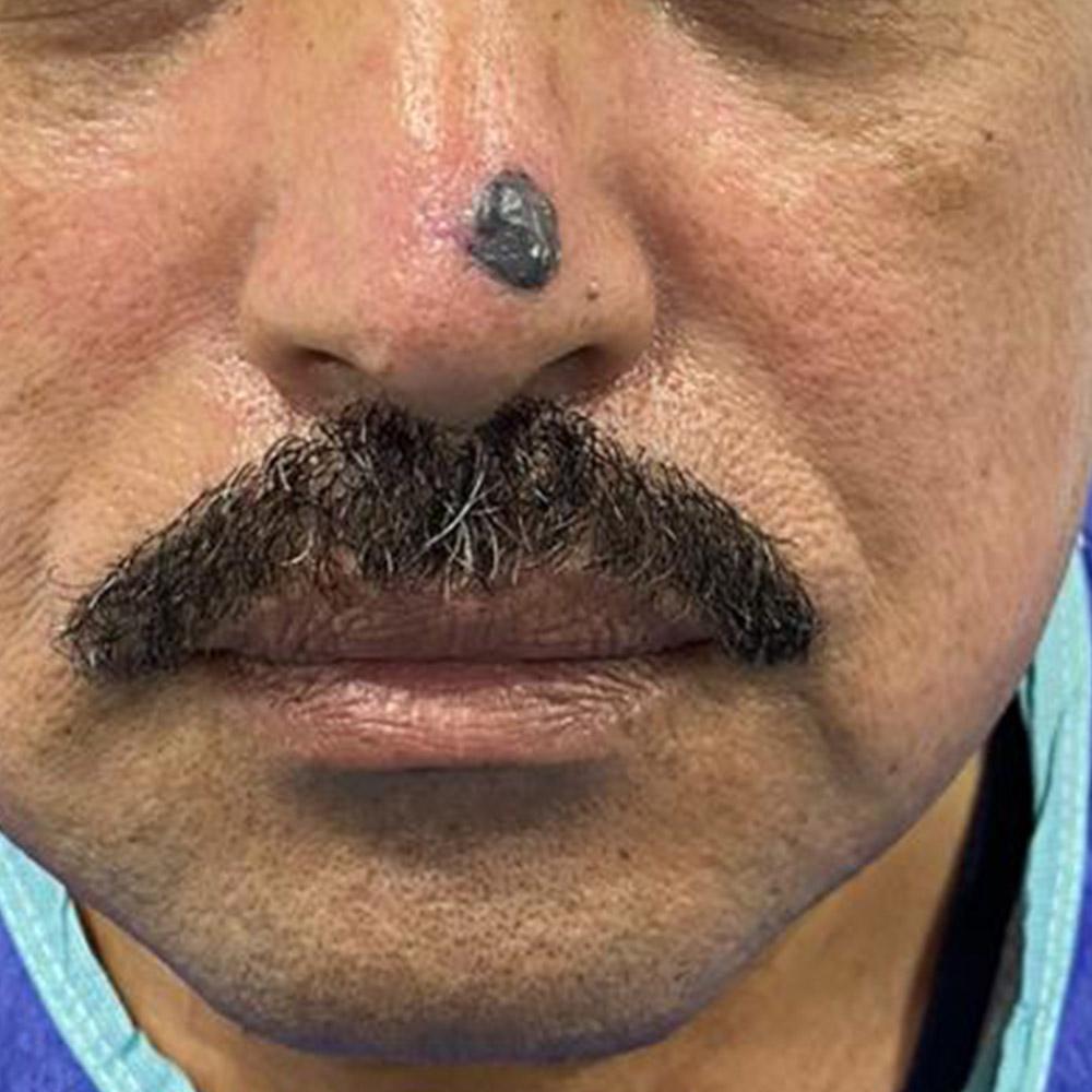 basal cell carcinoma of the nose