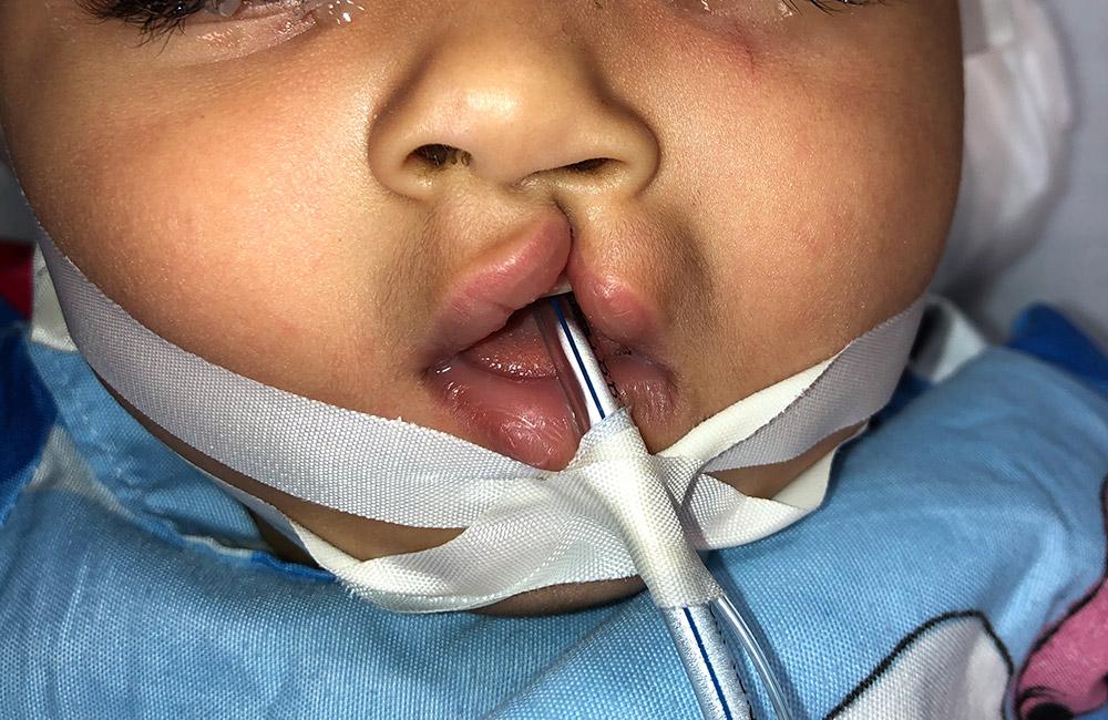 cleft lip and palate surgeries