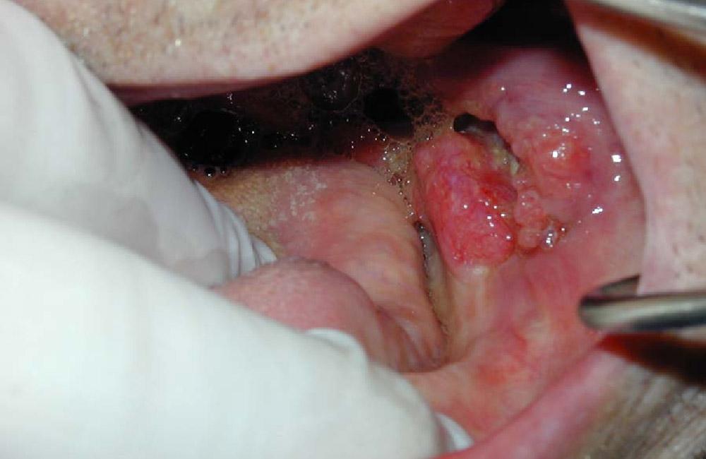 oral and skin cancer surgeries