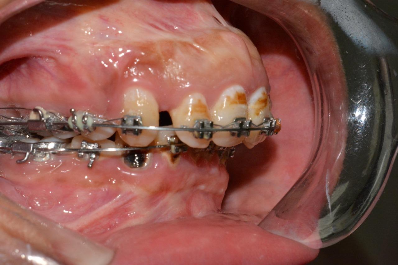 orthognathic surgeries